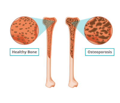 osteoporosis2.png